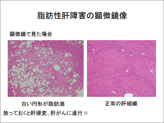 脂肪性肝障害の顕微鏡像