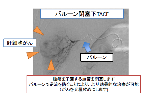 腫瘍を栄養する血管を閉塞します。バルーンで逆流を防ぐことにより、より効果的な治療が可能(がんを兵糧攻めにします)