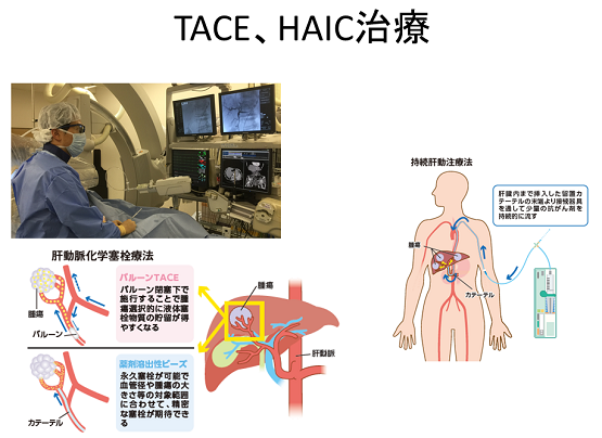 TACE、HAIC治療