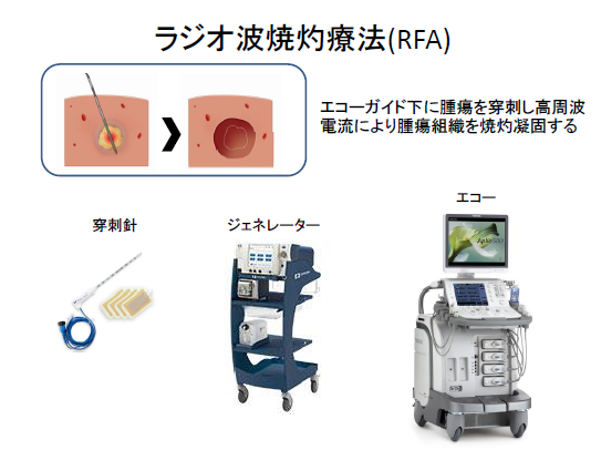 ラジオ波焼灼療法（RFA）