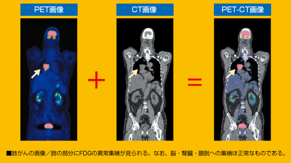 PET-CT画像