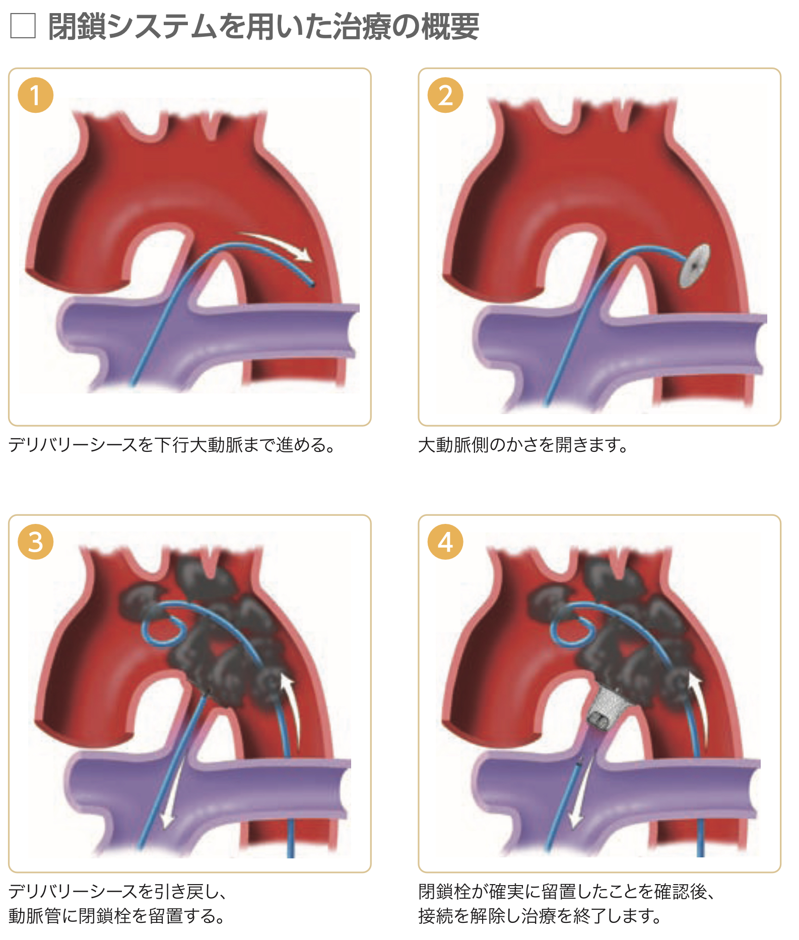 動脈管開存症の経皮的閉鎖 | 循環器内科 | 仙台厚生病院