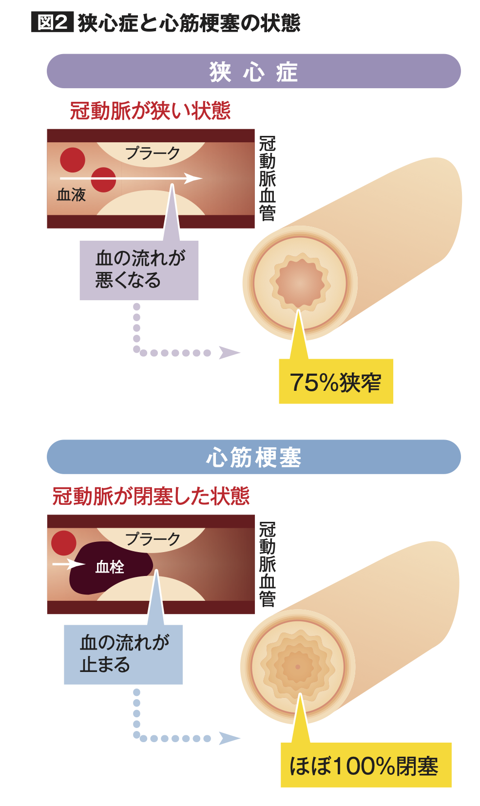 狭心症と心筋梗塞の状態