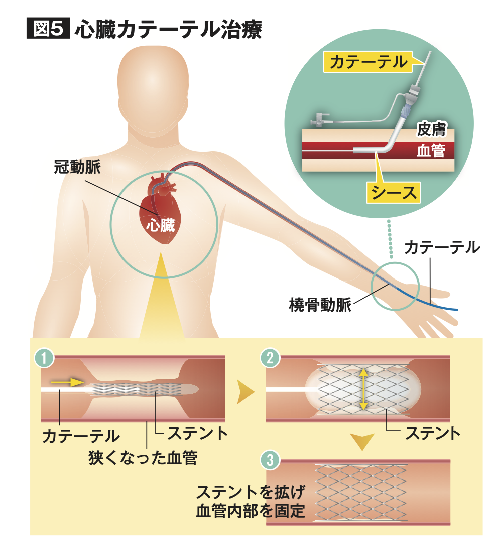 心筋 梗塞 カテーテル 手術