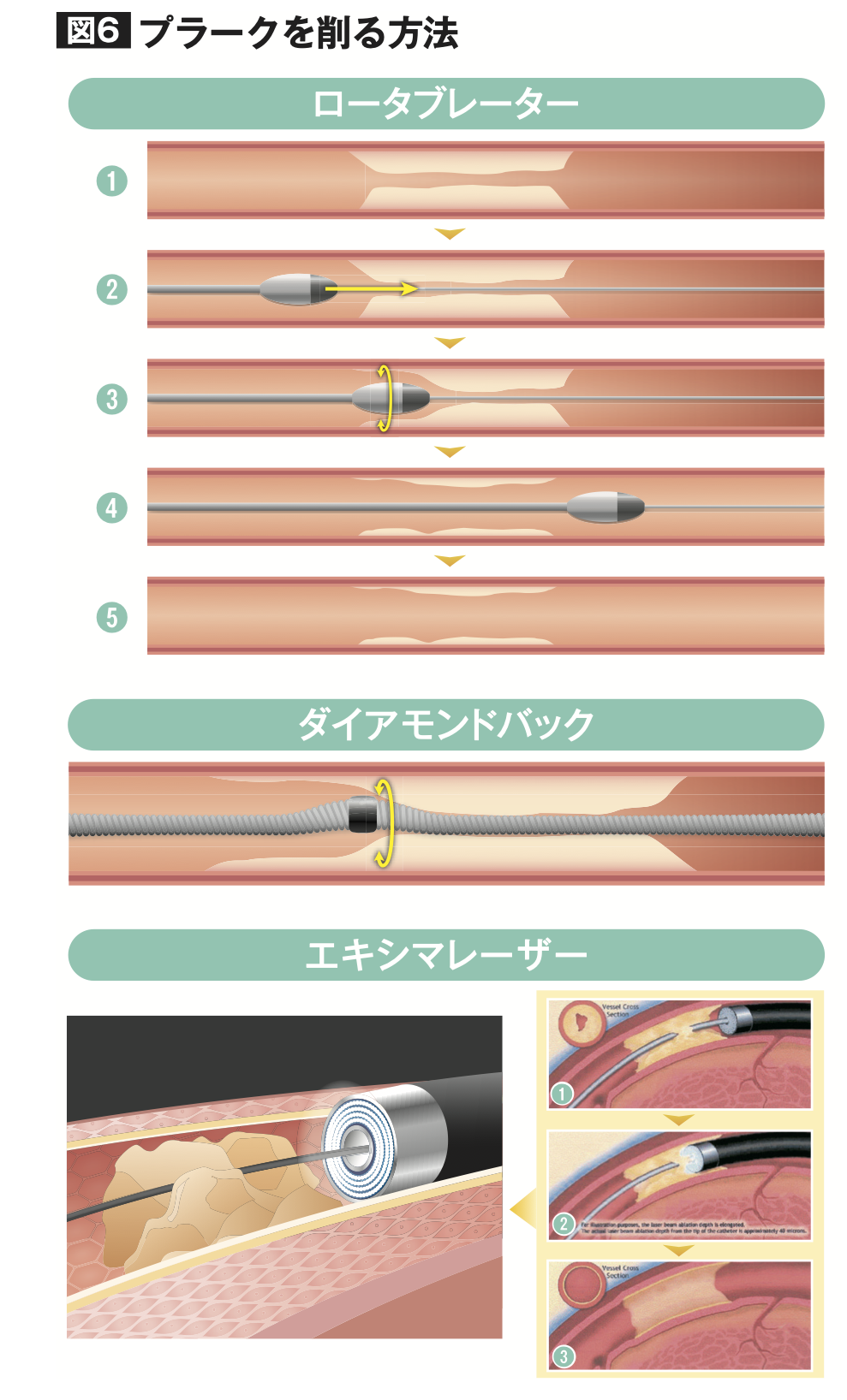 プラークを削る方法