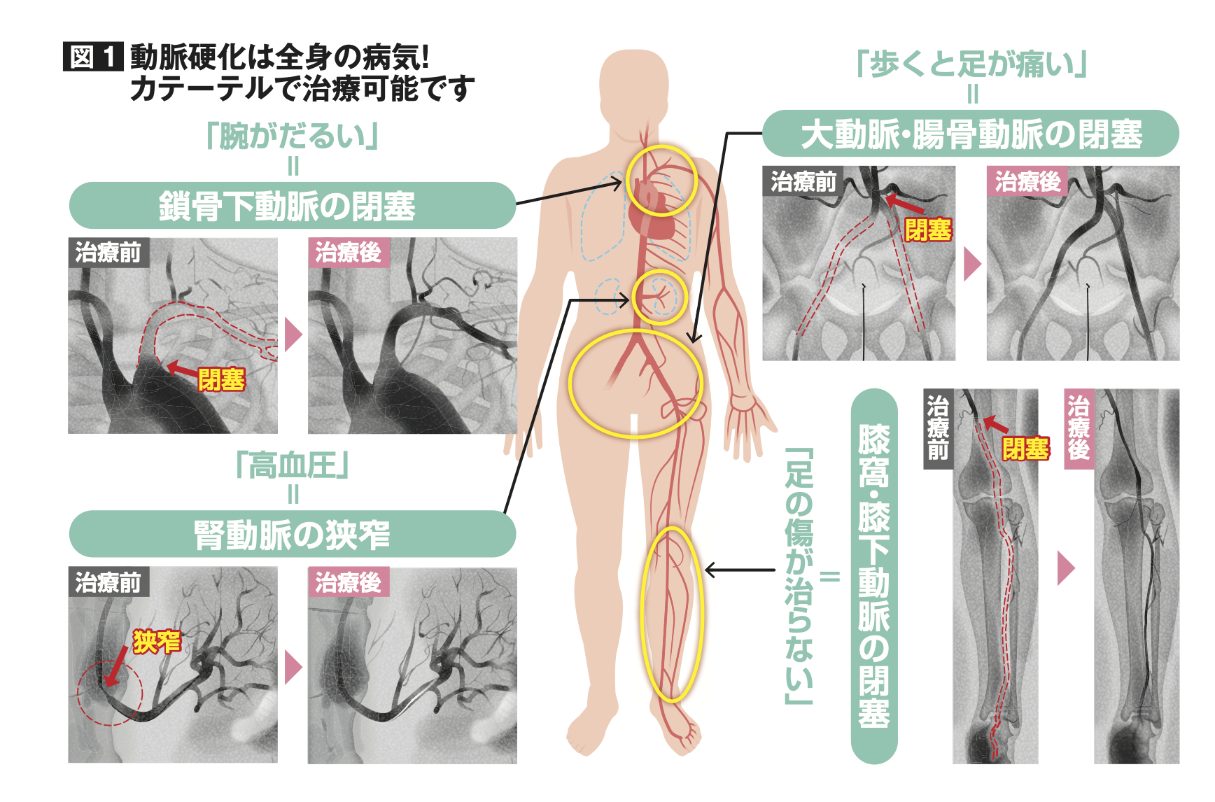 動脈硬化は全身の病気!カテーテルで治療可能です