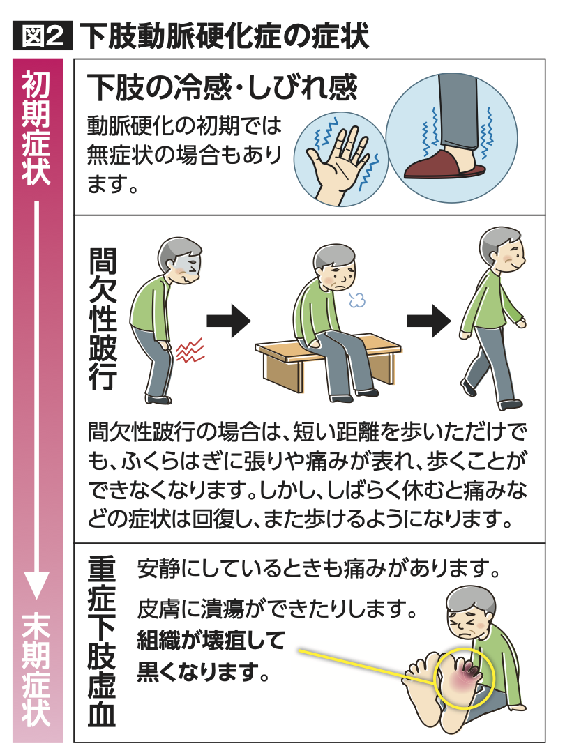 下肢動脈硬化症の症状