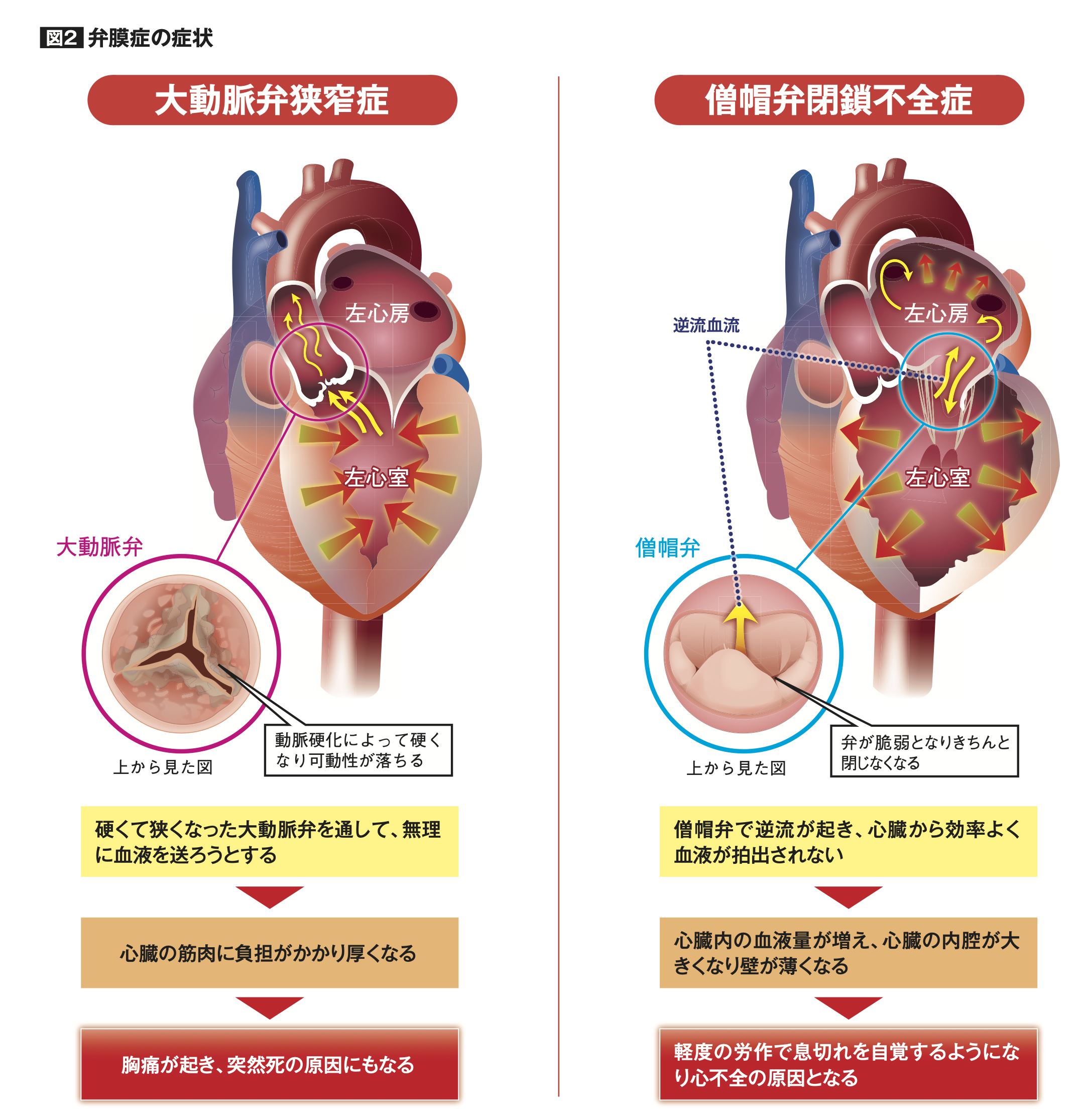 弁膜症の症状