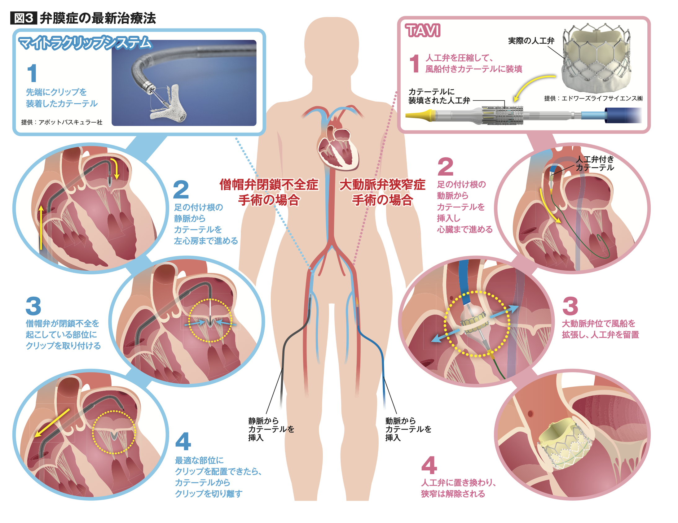 弁膜症の最新治療法