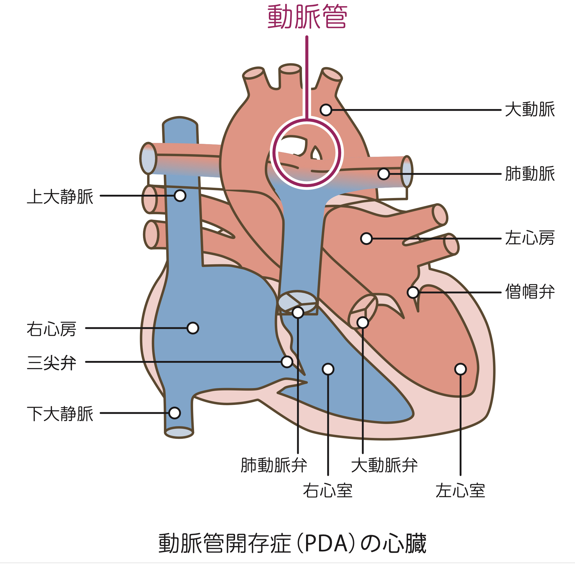 動脈管開存症を有する心臓